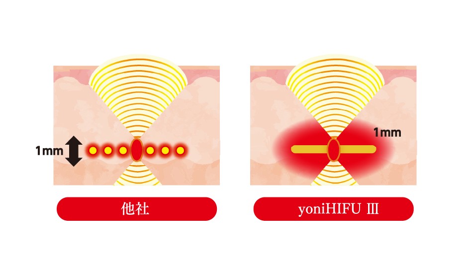 膣ハイフ