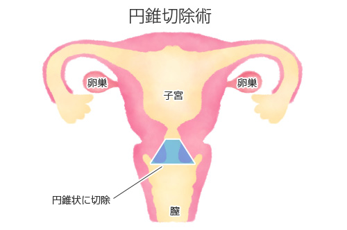形成 子 宮頸 異 が ん 子宮頸癌