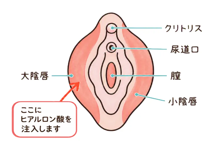 外陰部の解剖図。クリトリス・尿道口・膣・小陰唇・大陰唇の位置と、ヒアルロン酸を注入する大陰唇の部位を示している