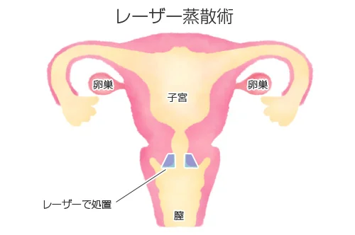 レーザー蒸散術:病変部の表面のみをレーザーで処置するイメージ