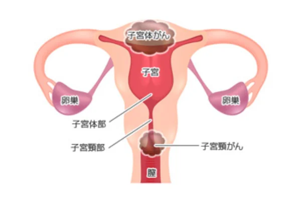 子宮頚がん・子宮体がんができる部位を示す図